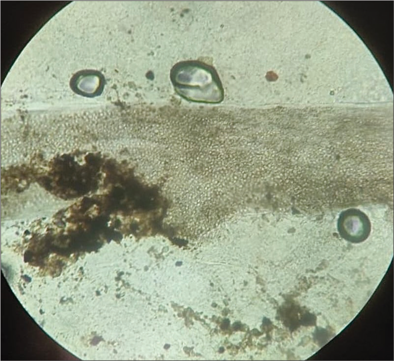Microscopy of potassium hydroxide mount of a plucked hair showing intrapilary arthroconidia (×400).