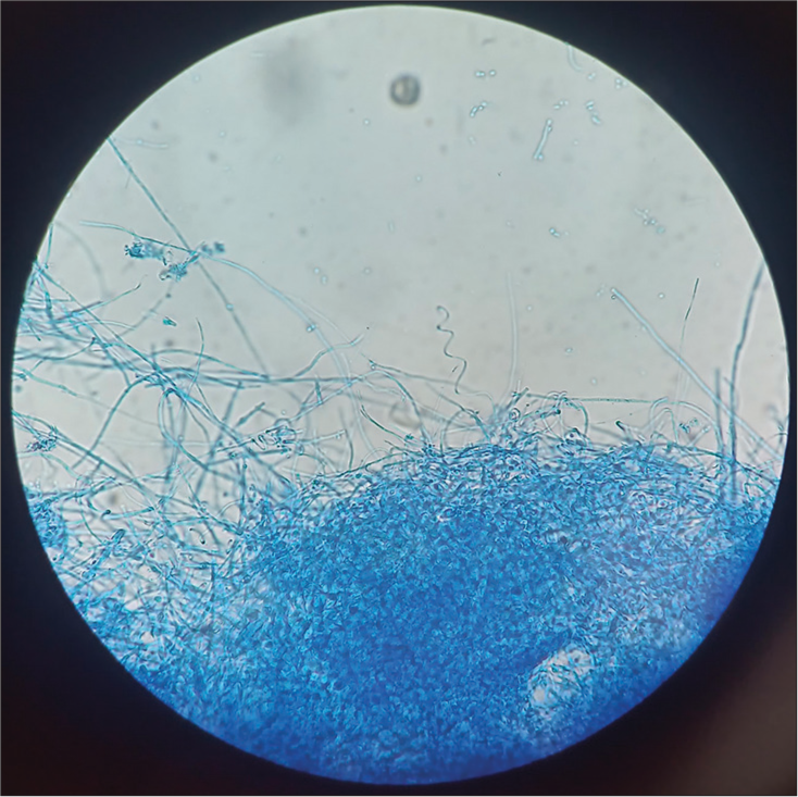 Microscopy of lactophenol cotton blue mount from the culture on Sabouraud dextrose agar at 25° C showing spiral hyphae (×100).