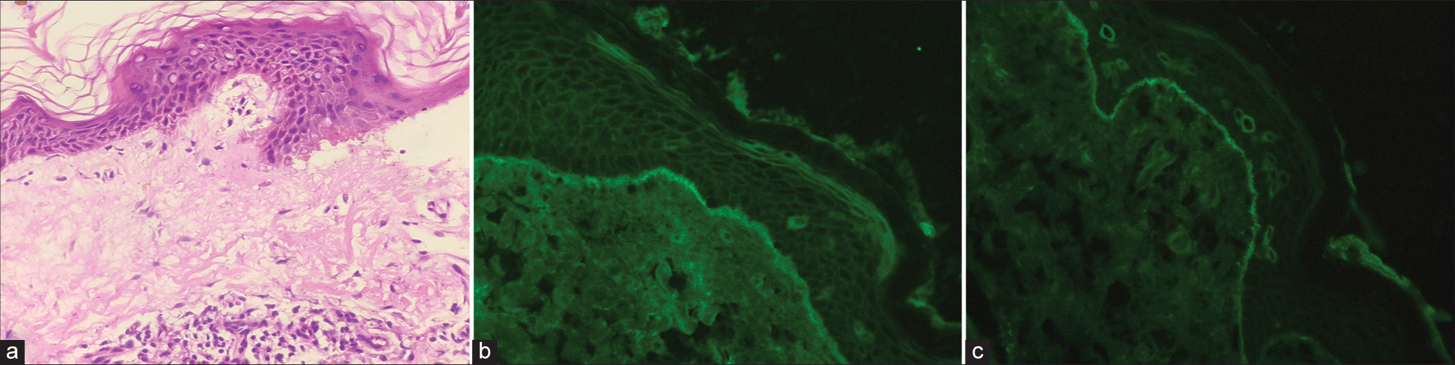 (a) Spongiosis of the epidermis and a subepidermal blister with neutrophils (H&E x100). (b) Linear deposits of immunoglobulin G on direct immunofluorescence (DIF). (c) Linear deposits of immunoglobulin A on DIF.