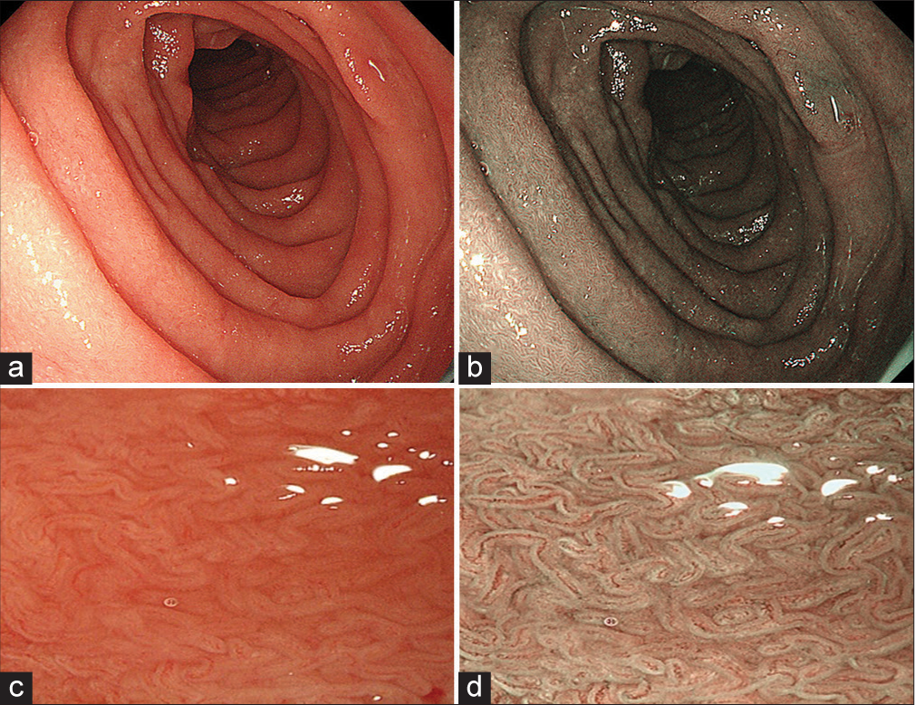 (a) Conventional esophagogastroduodenoscopy showing continuous and regular duodenal mucosa and (c) flattening of villi. (b and d) Narrow band imaging showing irregular arrangement and flattening of villi on duodenal mucosa suggestive of villous atrophy.