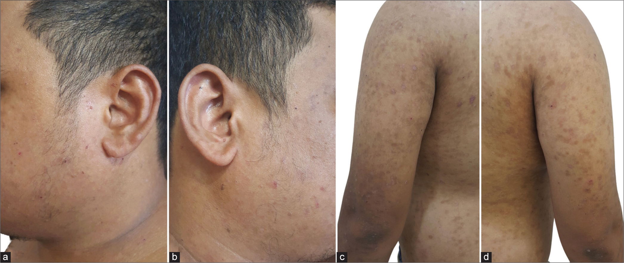 Drying and healing of skin lesions on the (a and b) face and (c and d) trunk on follow-up.