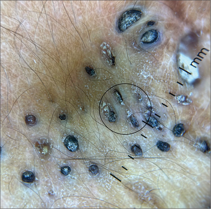 Non-polarized dermoscopy at ×20 magnification showing multiple, closely grouped, dark brown to black follicular openings filled with keratinous plugs surrounded by a whitish halo (black circle).