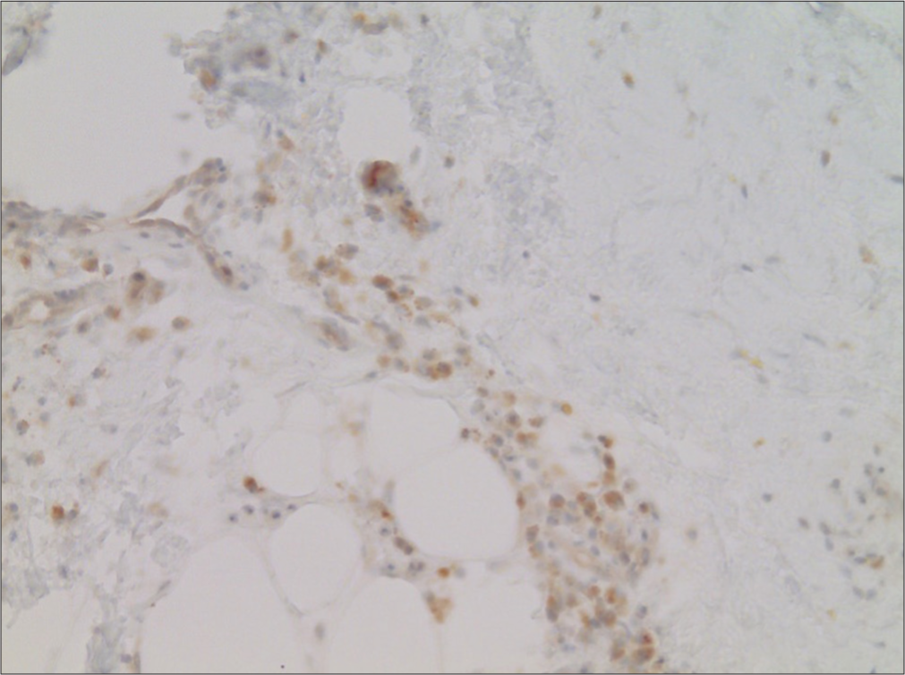 Detection of SARS-CoV-2 spike subunit 1 in endothelia of small caliber blood vessels in the subcutaneous adipose tissue (Immunoperoxidase, ×20).