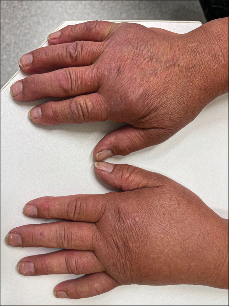 Lymphedema on the left side (Patient 2).