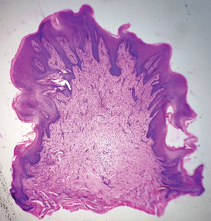 Epidermal hyperplasia characterized by acanthosis, papillomatosis, and elongated rete ridges together with dermal nodular fibroblast hyperplasia and dense collagen [H and E, ×40].