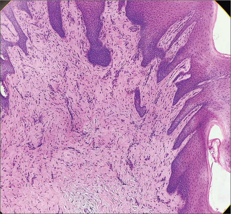 High-power view showing mature spindle-shaped fibroblasts, thickened collagen bundles, a few scattered blood vessels, and mild inflammatory infiltrate [H and E, ×100].