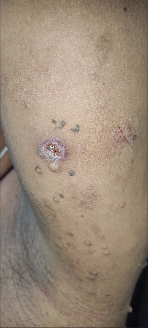 Wound healing phase (picture taken after 7 days of excision).