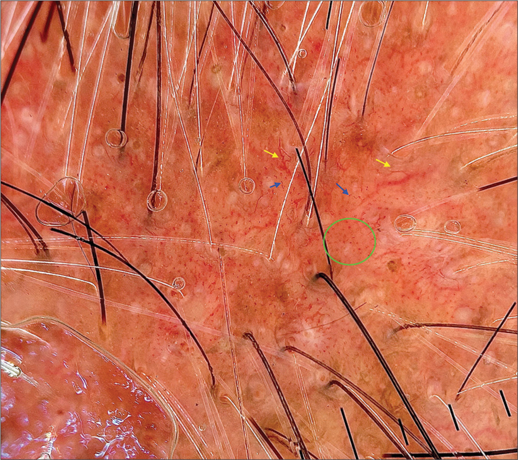 Polarized dermoscopy [Heine DELTAone] showing arborizing (yellow arrows), comma (navy blue arrows) and dotted vessels (green circle) on an erythematous background in seborrheic dermatitis (×20).