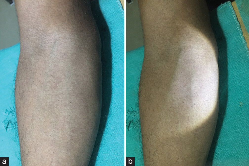 (a) The visibility of vein is less in normal or room light and (b) the visibility of vein is better in tangential light.