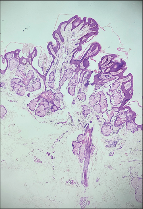 Histologic section showing papillomatosis and acanthosis of the epidermis along with follicular plugs. Multiple sebaceous lobules are noted adjacent to the epidermis in the superficial and mid-dermis (H and E; ×40).