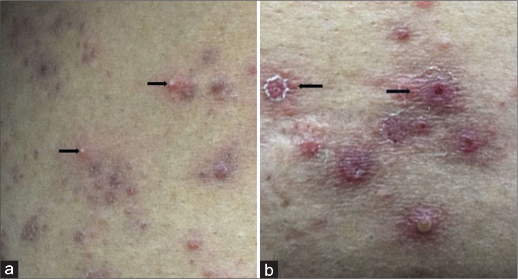 (a) Follicular pustule, and (b) erythematous crusted papule with rosette formation.