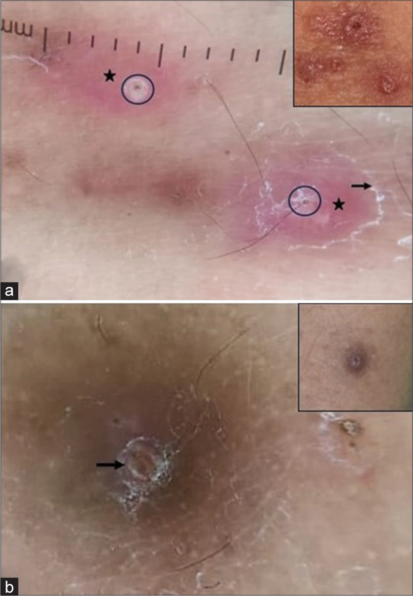 (a) Dermoscopy showing follicular yellow-white area (black circle), perifollicular yellow-orange structureless area (black star) and peripheral white scaling (black arrow) and (b) crust with peripheral pigmentation (black arrow) [DermLite DL4, polarized, ×10 magnification].