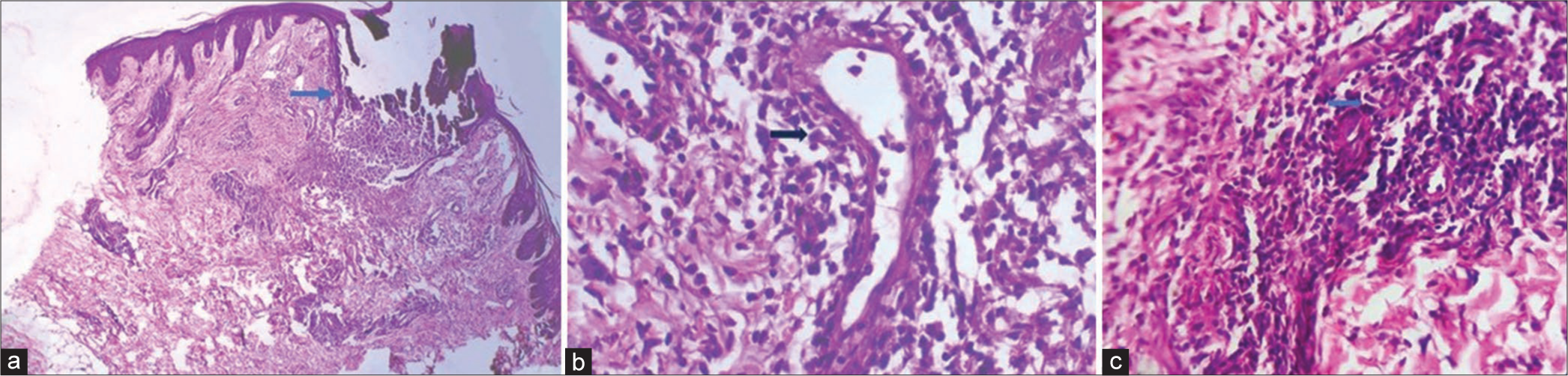 (a) Scanner view showing wedge-shaped necrosis of epidermis extending till mid dermis with periappendageal granulomatous collection (blue arrow) [H and E, ×40], (b) dilatation of blood vessels with perivascular neutrophilic and lymphocytic infiltrate (black arrow) [H and E, ×100], and (c) collection of inflammatory cells such as lymphocytes, histiocyte, and epithelioid cells forming granulomas in the deep dermis (blue arrow) [H and E ×400].