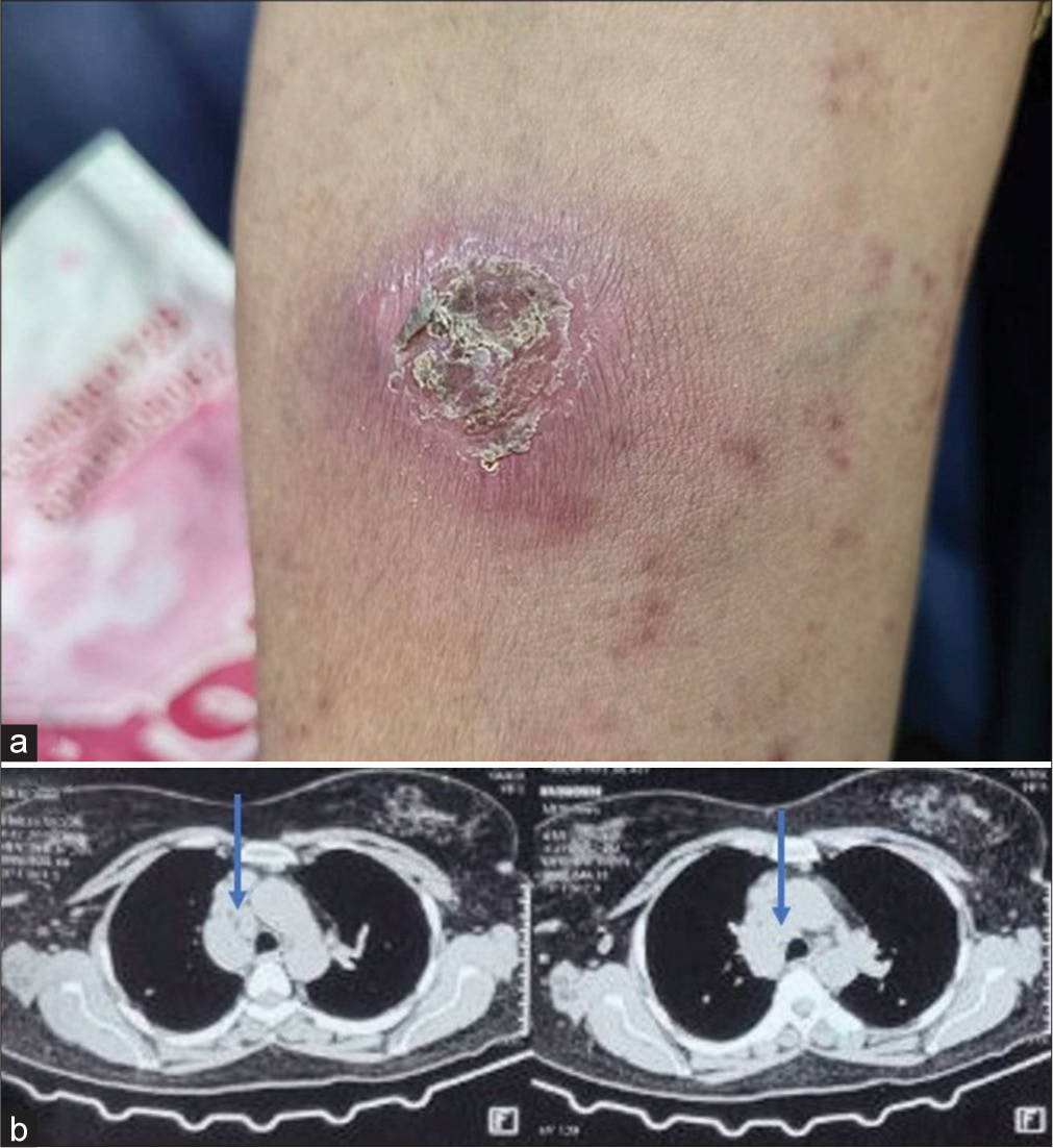 (a) Strongly positive Mountox test and (b) high-resolution computed tomography thorax showing enlarged mediastinal lymph nodes (blue arrow).