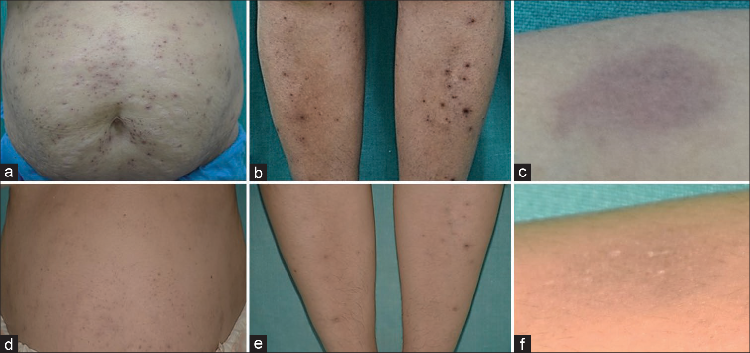 (a-c) Post-treatment after 4 weeks and (d-f) post-treatment after 4 months.