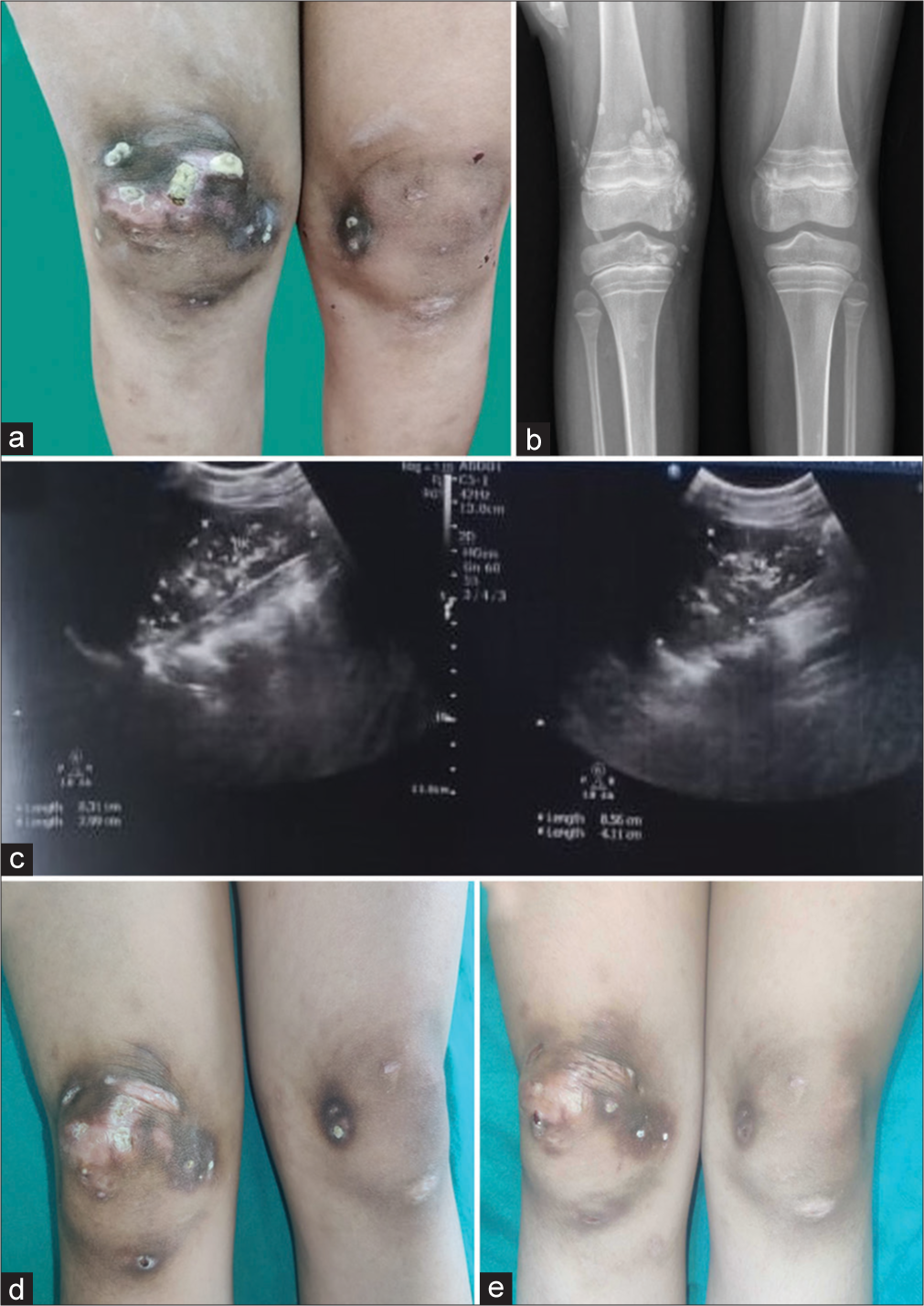 (a) Well-defined, erythematous to hyperpigmented noduloplaques with surfaces showing white, gritty hard deposits over both knees. (b) X-ray of lower limbs showing diffuse soft tissue calcifications. (c) Ultrasound abdomen showing multiple calcific foci dispersed throughout the renal cortex. (d) Post treatment image showing good response in calcinosis cutis at 3 months. (e) Post treatment image showing good response in calcinosis cutis at 6 months.