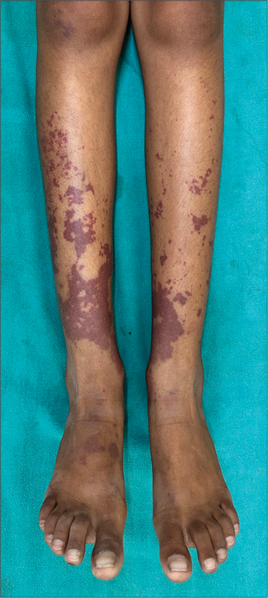 Multiple non-blanchable discrete purpuric macules and papules coalescing to form larger macules and plaques on the extensor surfaces of the legs.