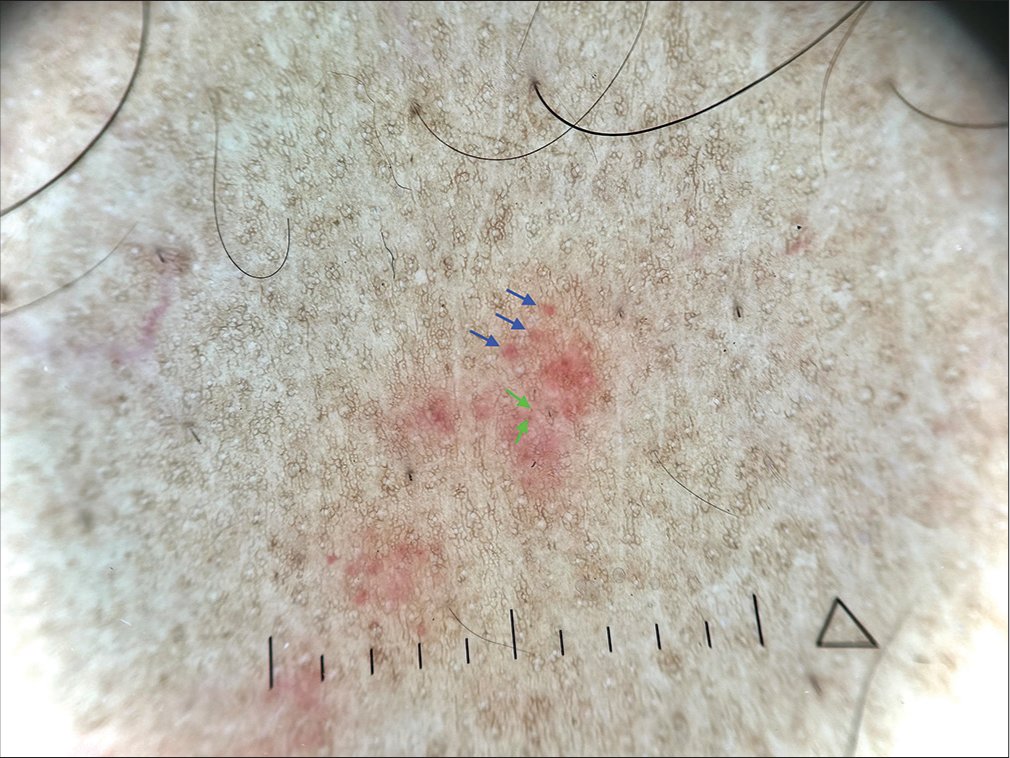 Polarized dermoscopy (Heine DELTAone) of the purpuric lesions showing a pattern of red dots (green arrows) and globules (navy blue arrows) on a reddish background (×20).