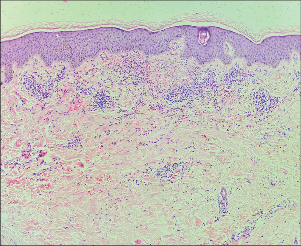 Histological section showing fibrinoid necrosis of vessel walls, neutrophilic infiltration, leukocytoclasia, and perivascular infiltrate involving the vessels in the superficial and mid dermis. Extravasation of red blood cells and dermal edema is also prominent (Hematoxylin and eosin; ×100).