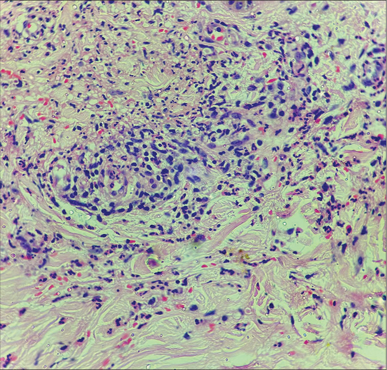 Histological section showing fibrinoid necrosis and neutrophilic infiltration of vessel wall with leukocytoclasia. The perivascular infiltrate is composed of neutrophils, lymphocytes, and histiocytes (Hematoxylin and eosin; ×400).