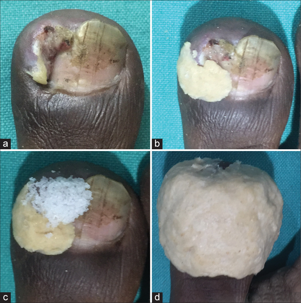 (a-d) The different stages of the procedure of table salt and wheat flour dough application over pyogenic granuloma.