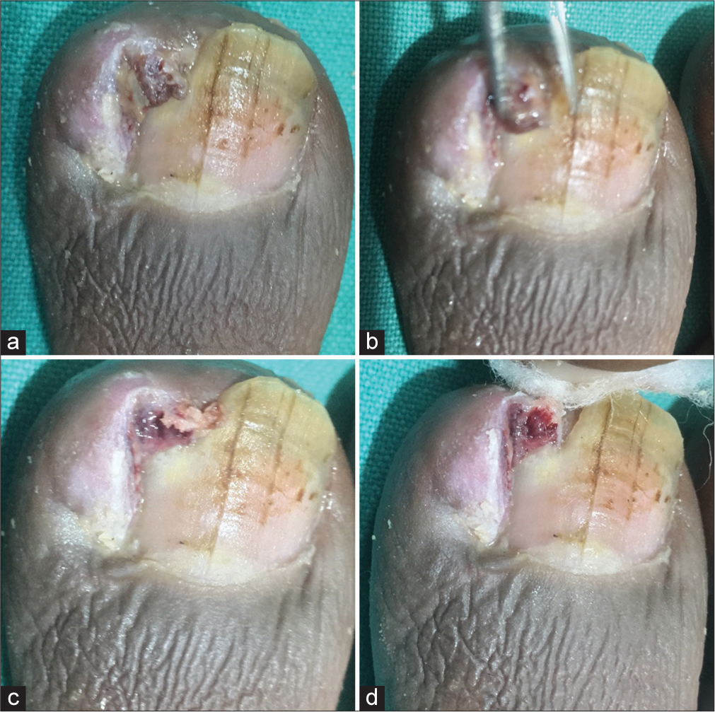 (a-d) The different stages of granuloma: Faded, shrunken, and easily removed with forceps and gauze piece after one week.