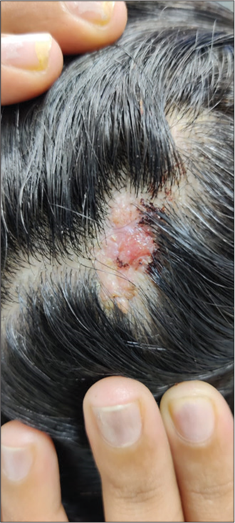 Verrucous outgrowth on scalp.