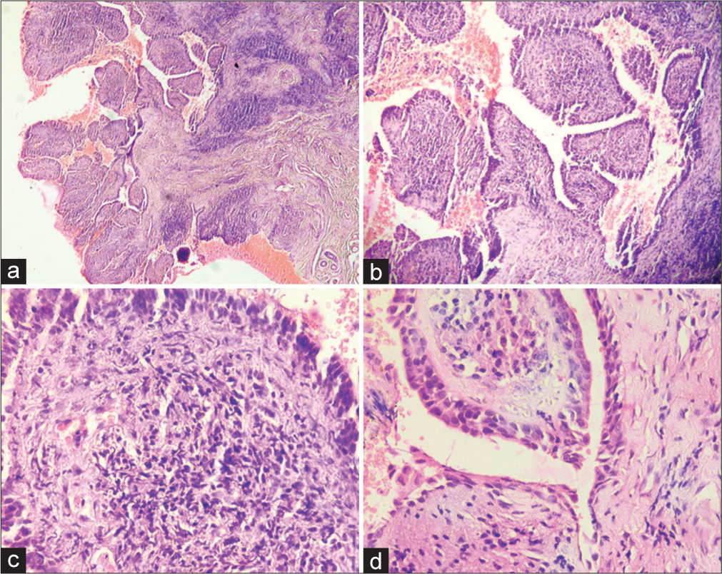 (a) Low-power view shows epidermis thrown into exophytic papillary fronds and dense inflammatory infiltrate in the papillary stroma and dermis (H&E stain, ×40); (b) low-power view shows papillary fronds liner by dual cell layer and dense inflammation in the papillary stroma (H&E stain, ×100); and (c and d) high-power view shows the papillary fronds lined by dual cell layer and stroma shows dense lymphoplasmacytic inflammatory infiltrate (H&E stain, ×400).