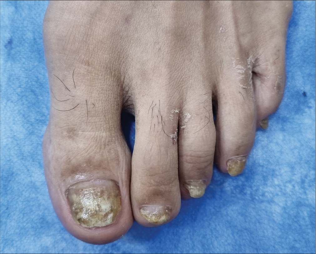 Total dystrophic onychomycosis accompanied with tinea pedis.