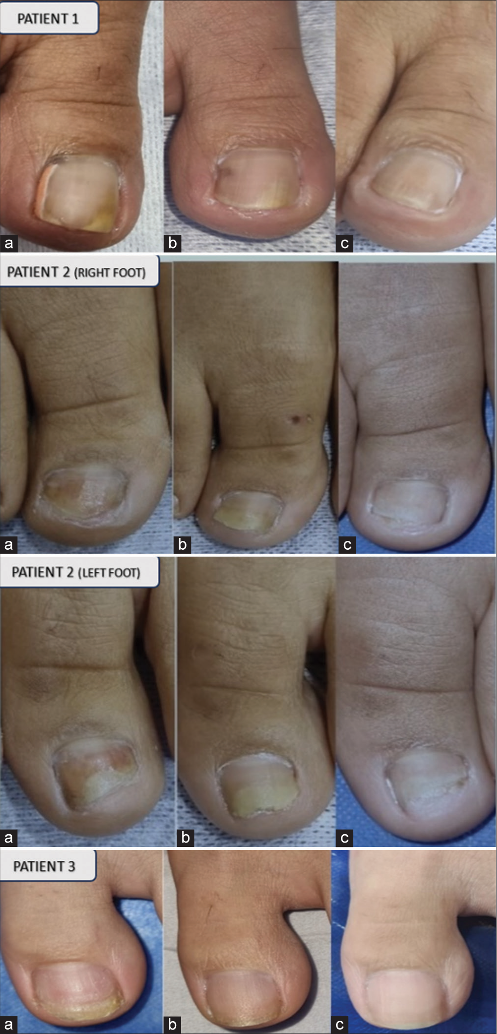 Clinical appearance of nails with onychomycosis before the laser sessions (images a), at the end of 6 sessions (images b) and at 6 months follow-up (images c).