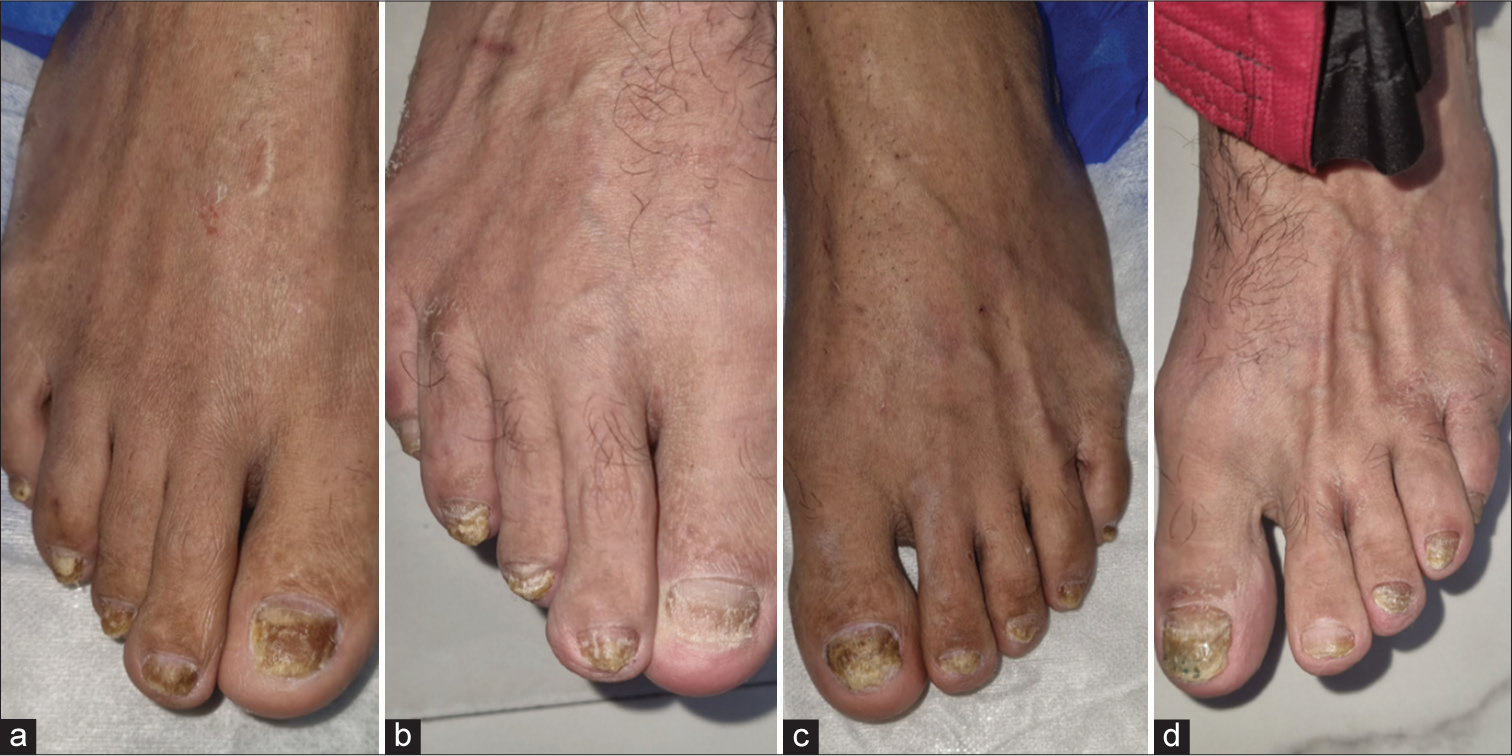 A patient on methotrexate with highly hyperkeratotic nails in right foot (a) and left foot (c). At the end of six sessions, he showed mild improvement in right foot (b) and left foot (d) in the form of decrease in hyperkeratosis and decrease in the area of involvement in few nails.