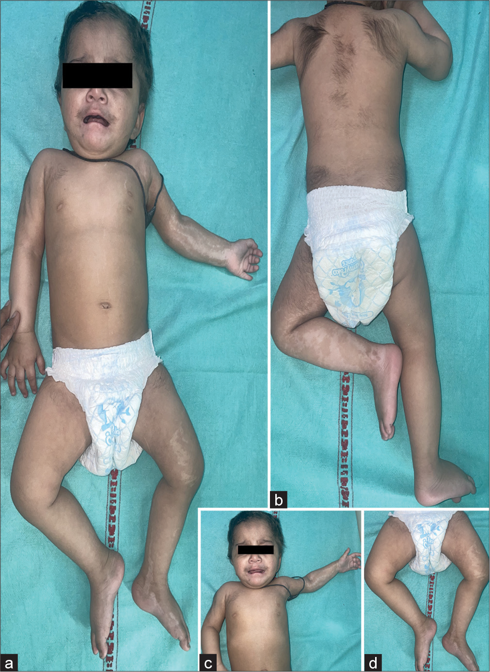 (a) Increased hair growth over face and body and white spots over left side of body, (b) multiple patchy hypertrichosis, (c) Blaschkoid hypopigmentation on the left upper limb, and (d) Blaschkoid hypopigmentation on the left lower limb.