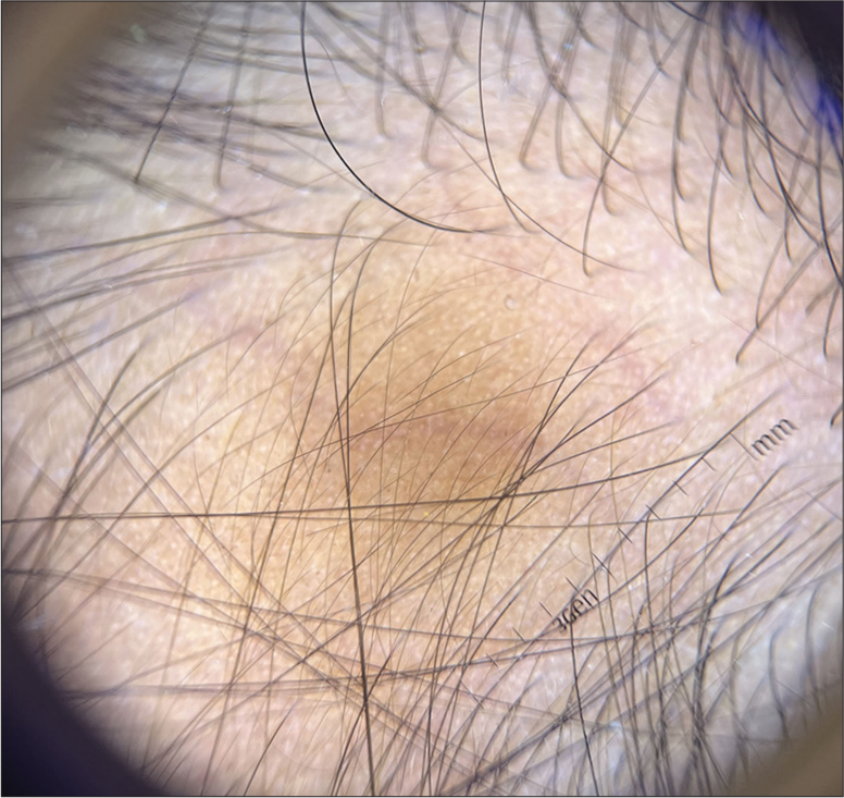 Trichoscopy (using DermLite™ DL3, San Juan Capistrano, CA, USA) showing a monomorphic pattern of vellus hairs of different lengths and reduced follicular density (Polarized mode, ×10).