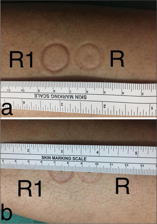 (a and b) The difference in impressions of the same device rim on right side of radius (R) and on left side of radius (R1) before and after 5 min suction on donor sites.