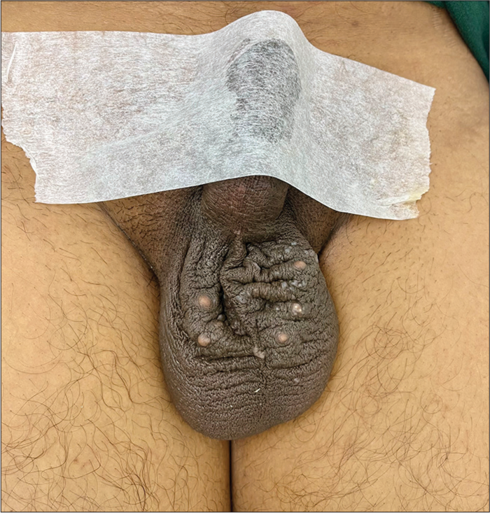 Image of the penoscrotal area with ventral penile taping (VPT) in position, demonstrating the correct technique for performing VPT.