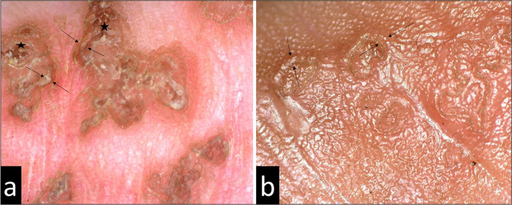 Dermoscopy showing characteristic rimmed edge (in between arrows) and pigmentation under the keratotic rim (star). (a) Dermoscopy done at presentation (Dino-Lite Edge digital microscope, ×50, polarized). (b) Comparison Dermoscopy done after 4 months (Dino-Lite Edge digital microscope, ×70, nonpolarized).