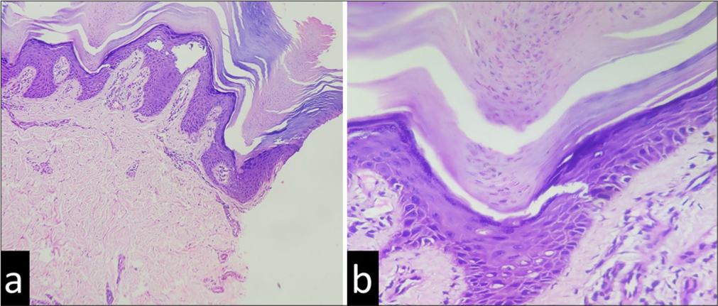 A biopsy of the plaque from the Achilles tendon shows multiple “cornoid lamellae,” invaginating through the epidermis (H and E, ×100) with underlying hypogranulosis at multiple foci (hematoxylin and eosin [H and E], ×400). (a and b) show a moderately dense perivascular upper dermal infiltrate, seen to be (b) lymphocytic in nature.