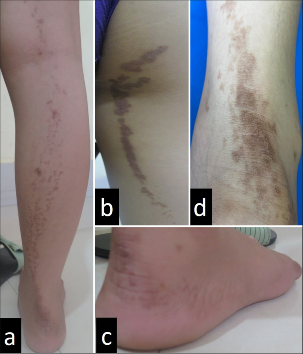 After four months of treatment, the patient is left predominantly with (a, b and c) post-inflammatory hyperpigmentation and (d) some residual keratotic plaques over the tendo-Achilles.