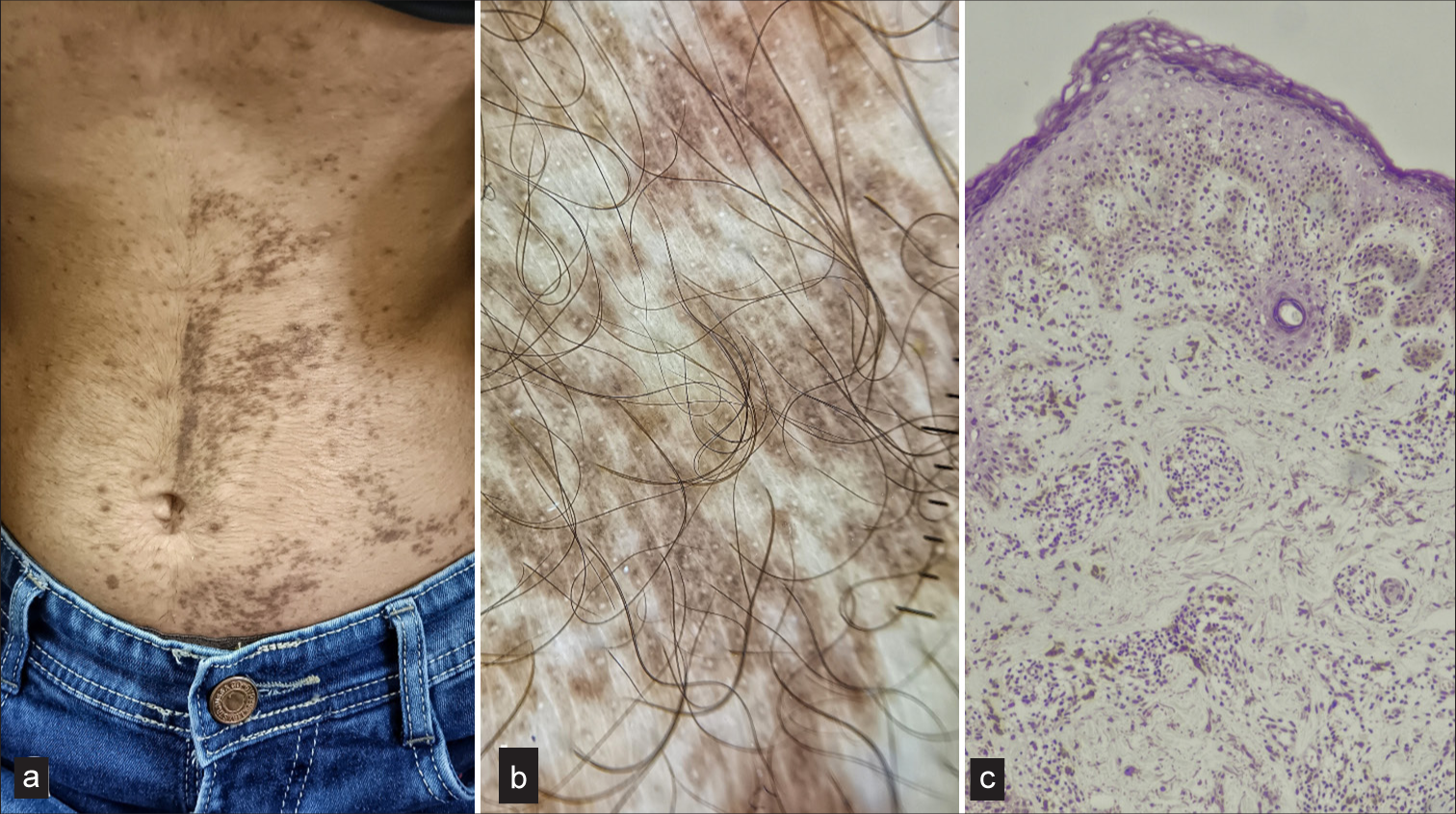 (a) Multiple discrete to confluent grayish hyperpigmented macules of variable size and shape over the left side of the abdomen with an irregular border and sharp midline cut-off. Furthermore, few discrete macules can be seen on the other side as well and upper trunk, (b) dermoscopy showing grayish background with a few scattered grayish dots and globules with peri-follicular and peri-eccrine accentuation and sparing of skin creases (Dermlite, DL4, ×10), (c) histopathological examination revealing an increase in basal layer pigment with interface dermatitis and pigment incontinence (Hematoxylin and Eosin ×100).