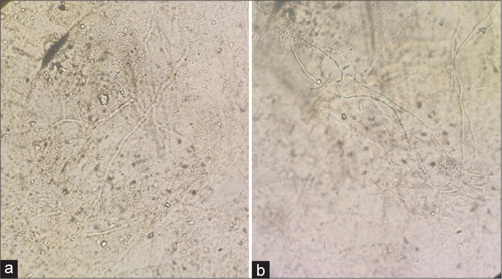 (a and b) Potassium hydroxide mount positive for fungal hyphae.