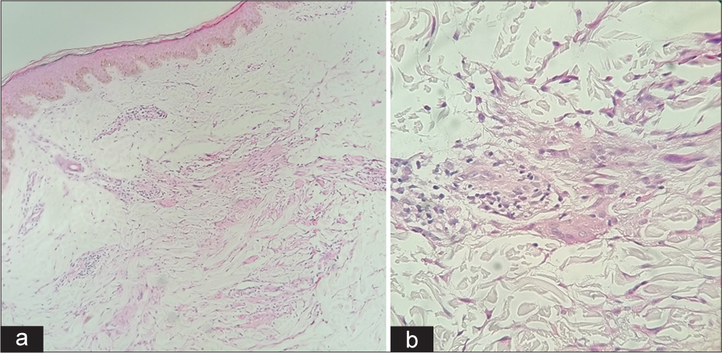 (a) Histopathology low power view showing epithelioid granulomas in the dermis [Hematoxylin and Eosin (H&E), ×10]. (b) Histopathology high-power view showing dermal epithelioid granulomas with lymphocytes with occasional Langhan’s giant cell (H&E, ×40).