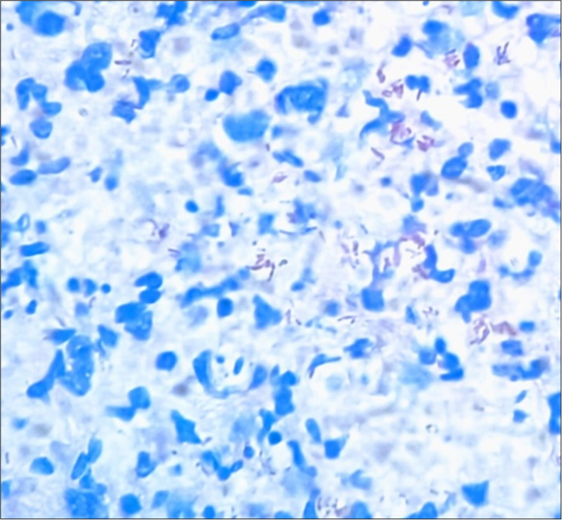 Fite-Faraco stain demonstrating scattered acid-fast bacilli with bacillary index of 1+ (FiteFaraco stain, ×40).