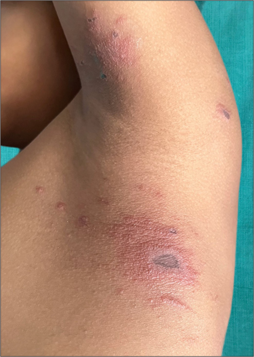 Well-demarcated erythematous plaques with vesicles, pustules, and a central zone of dusky erythema, displaying a mirror-image distribution in the infra-axillary area and the opposing medial proximal upper arm, indicative of “kissing lesions.”