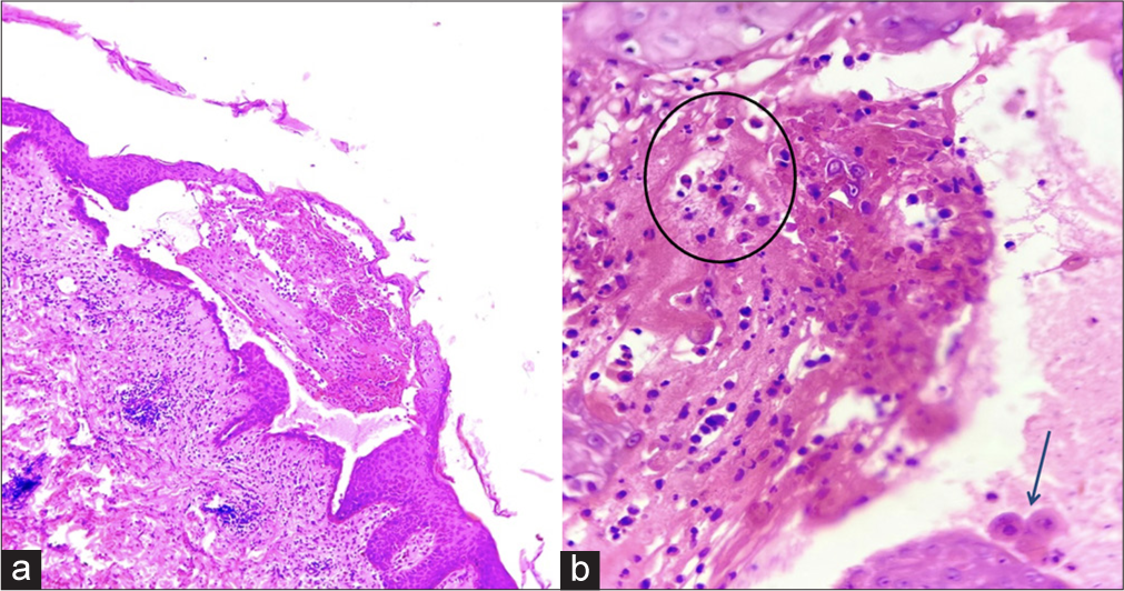 (a) Skin biopsy showing characteristic supra-basal split with intra-epidermal vesicle formation. Superficial dermis shows moderate degree of lymphocytic infiltrate (Hematoxylin and eosin; ×100), (b) The vesicle content shows eosinophils (circled) and few acantholytic keratinocytes (arrow) (Hematoxylin and eosin; ×400).