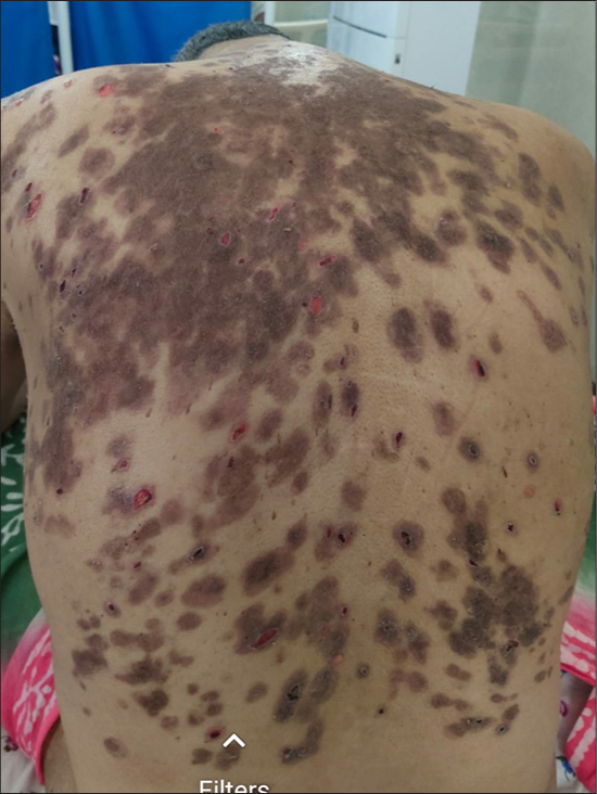 Two-week post-treatment, healed erosions with post-inflammatory hyperpigmentation and few small active erosions over the back.