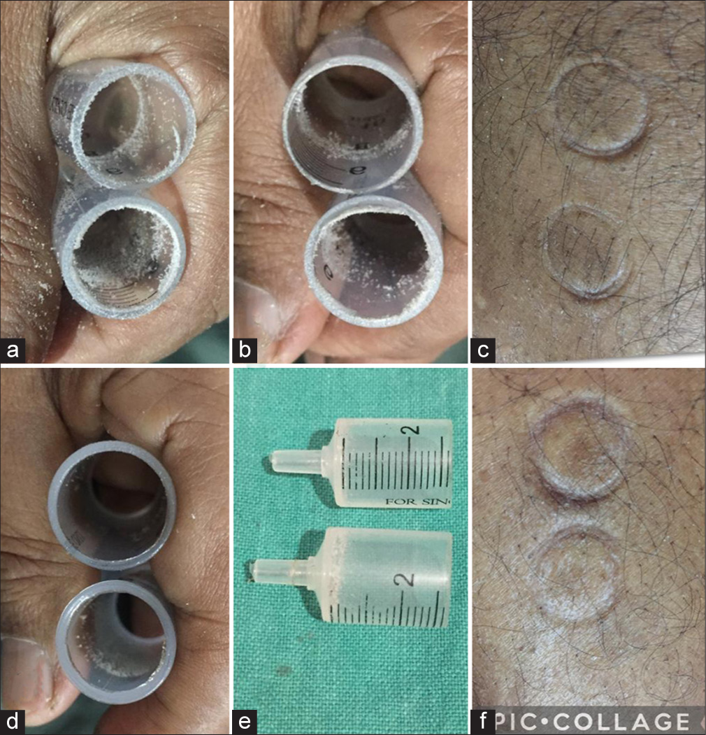 Modified suction syringe cup devices and their impressions on the skin (a-c) after rubbing on sandpaper with and without flakes and (d-f) after heating them in the vertical plane and showing thinner, smooth rims of which flakes were removed before heating.