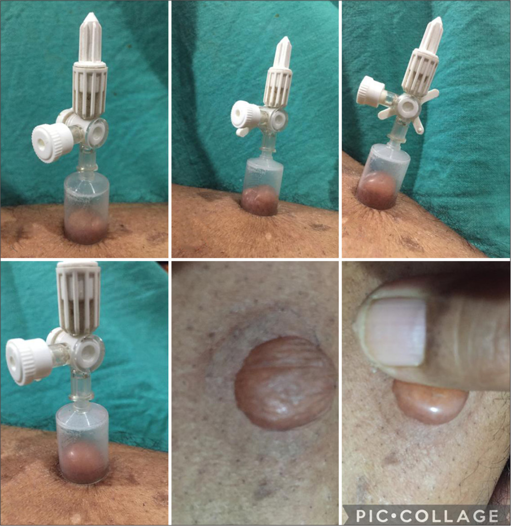 The different stages of the suction process and a unilocular blister produced with a small suction cup and lateral pressure (or intrablister normal saline) can be applied to inflate the periphery to increase the graft size.