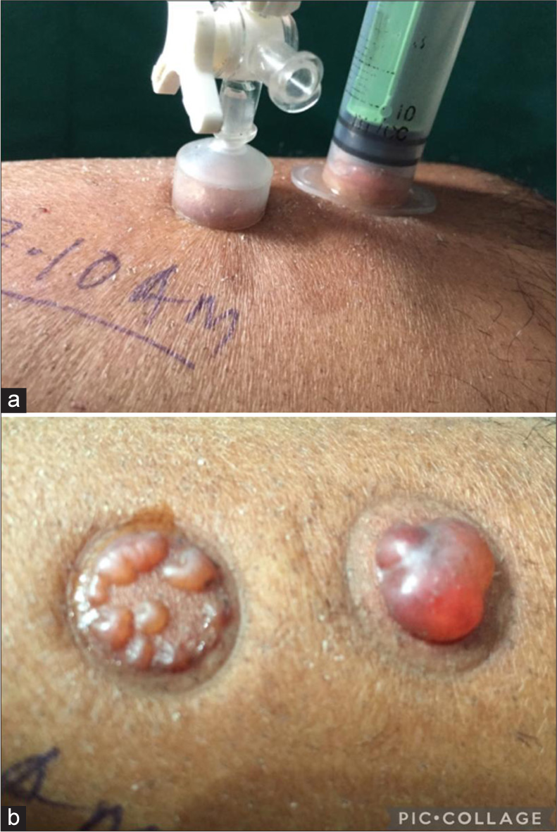 (a) A small air-leaked traumatic suction cup with multiple small blisters and (b) A small airtight suction syringe with unilocular large blister.