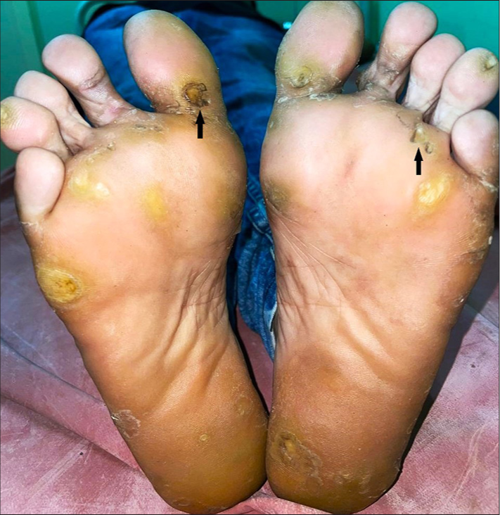 Hyperkeratotic yellowish plaques with erosions (arrow) and deep pits (arrow).