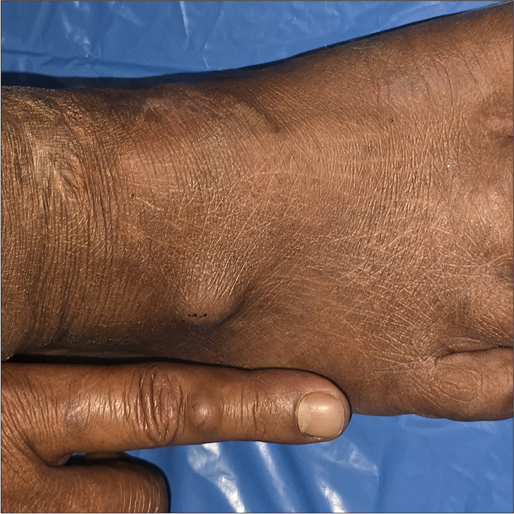 Disseminated phaeohyphomycosis presenting as well-to-ill-defined subcutaneous nodules on the dorsal aspect of the left foot and left index finger.